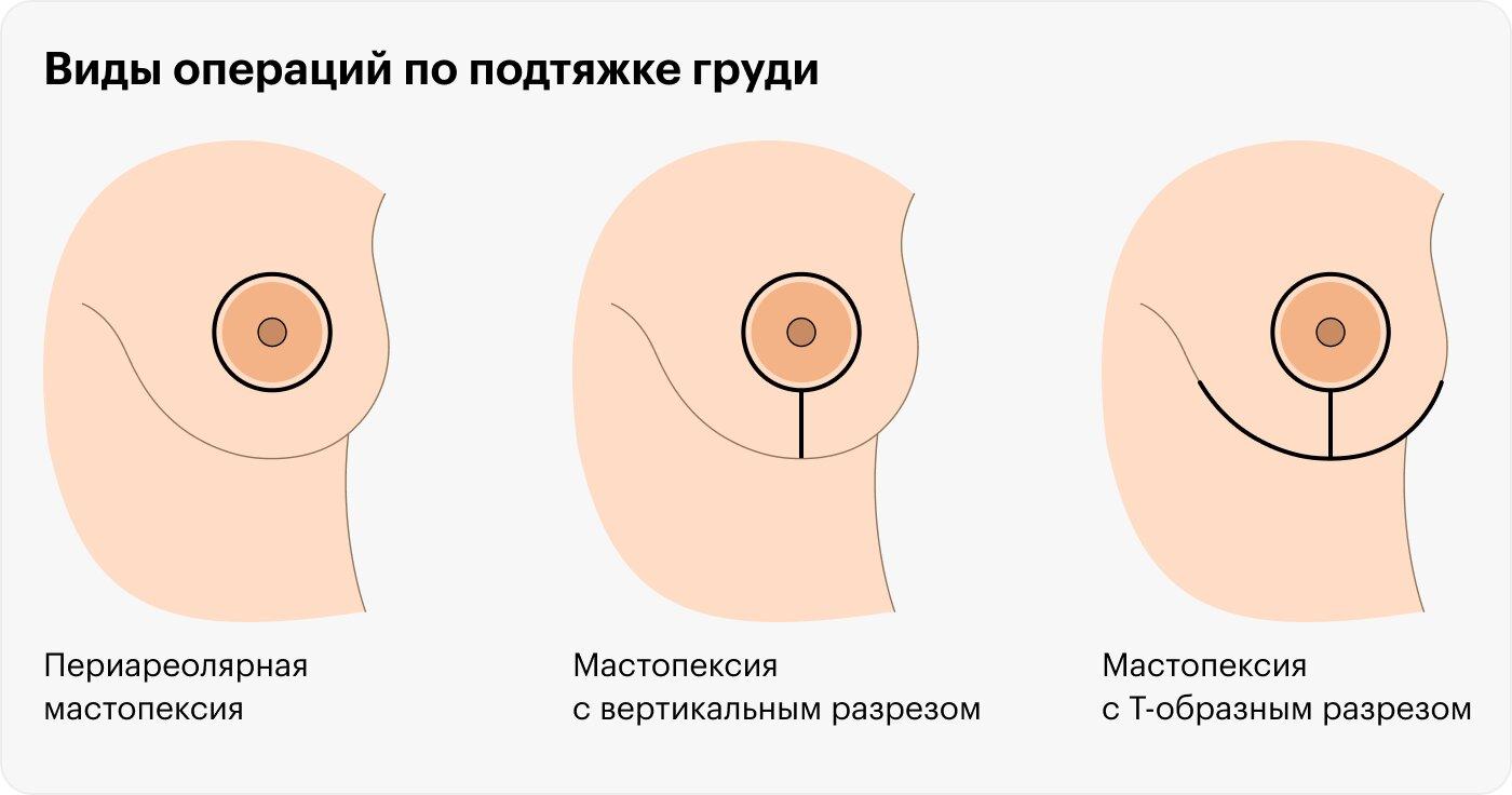 Техніки підтяжки грудей