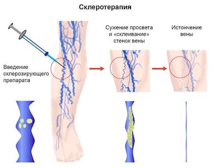 Склеротерапия вен Склеротерапия вен
