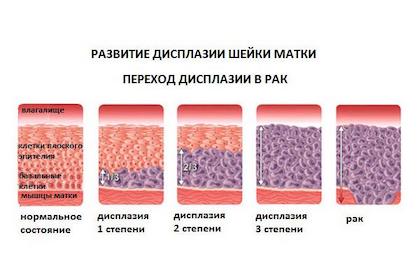 Дисплазія шийки матки 