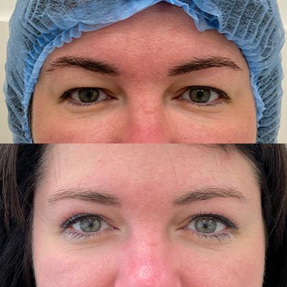blefaroplastyka