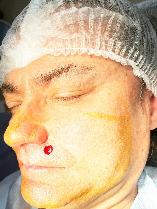 Видалення базаліоми шкіри методом Mosh Київ Видалення базаліоми шкіри методом Mosh Київ