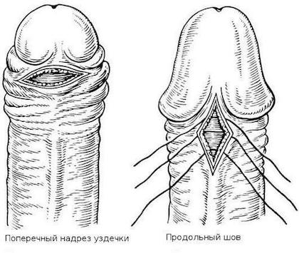 Пластика короткої вуздечки 