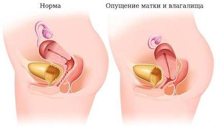 Опущение матки и стенок влагалища Опущение матки и стенок влагалища