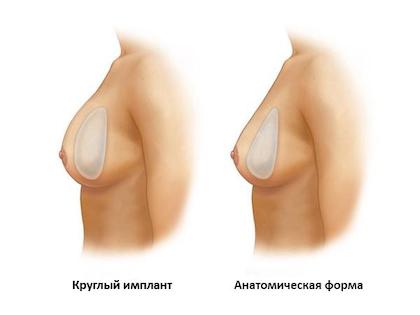 Форми імплантів