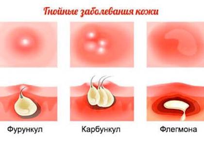 Запальні захворювання шкіри