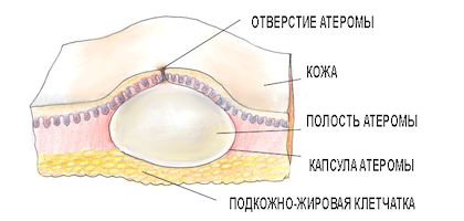 Атерома