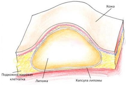 Липома Липома