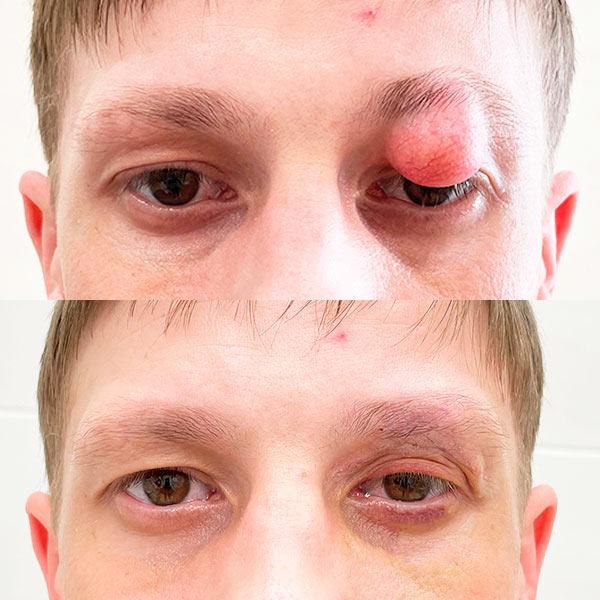 Удаление атеромы Киев