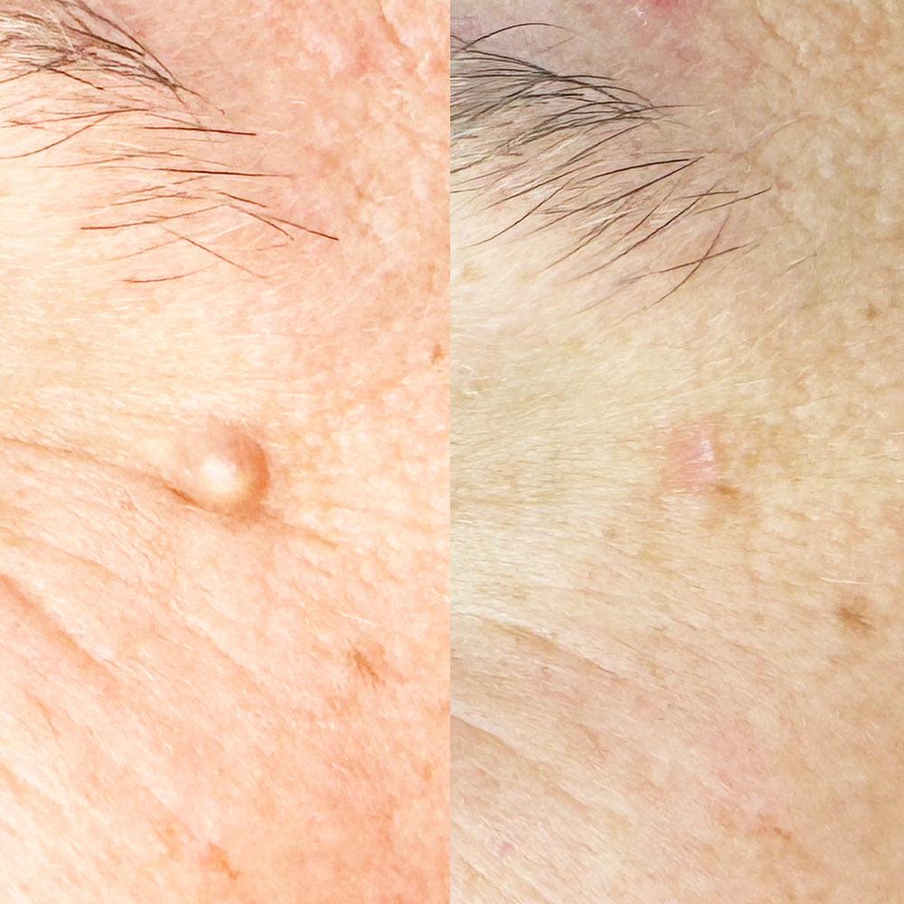 Лазерне видалення атероми на обличчі Київ