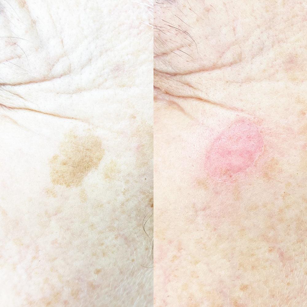 Удаление пигментации СО2 лазером Киев