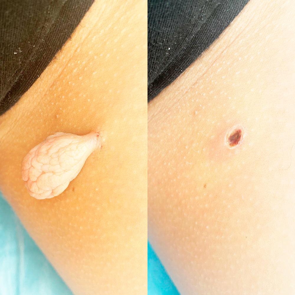 Видалення новоутворень в інтимній ділянці Київ