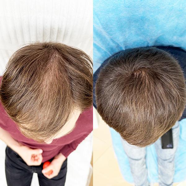 Лікування андрогенетичної алопеції Київ Лікування андрогенетичної алопеції Київ