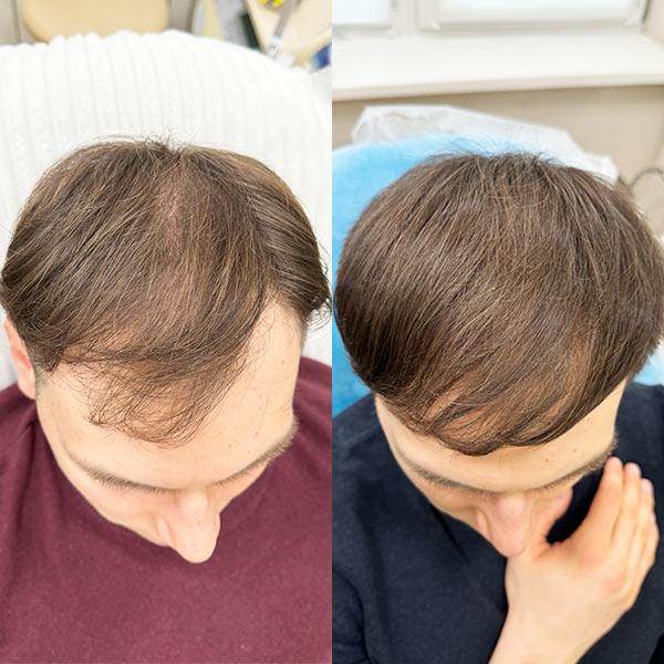 Плазмотерапія волосся + Дутабіот лікування андрогенетичної алопеції Київ