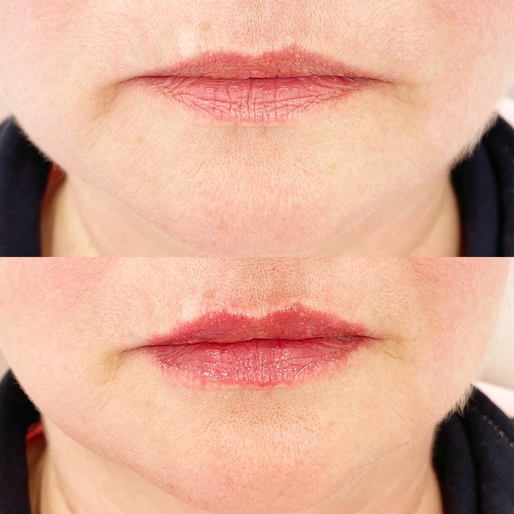 Контурная пластика губ Киев Контурная пластика губ Киев