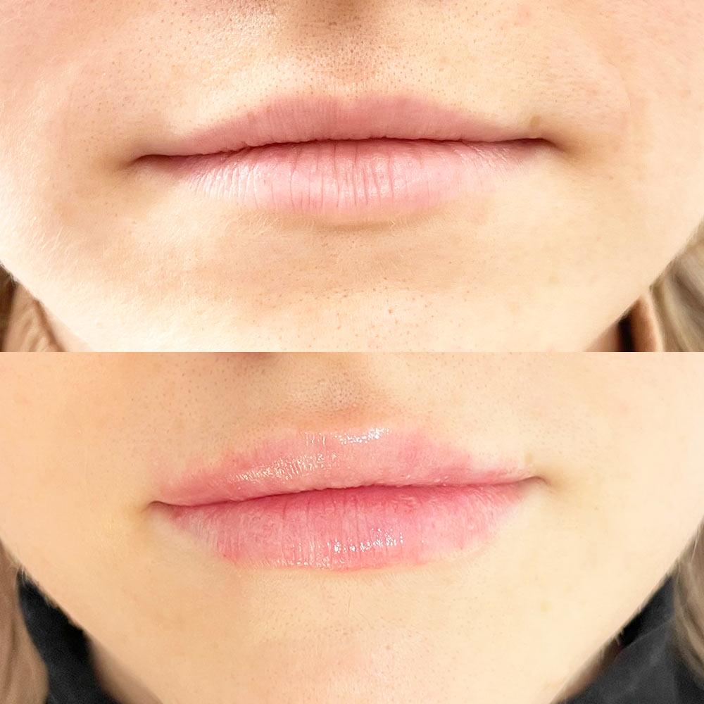 Збільшення губ Київ