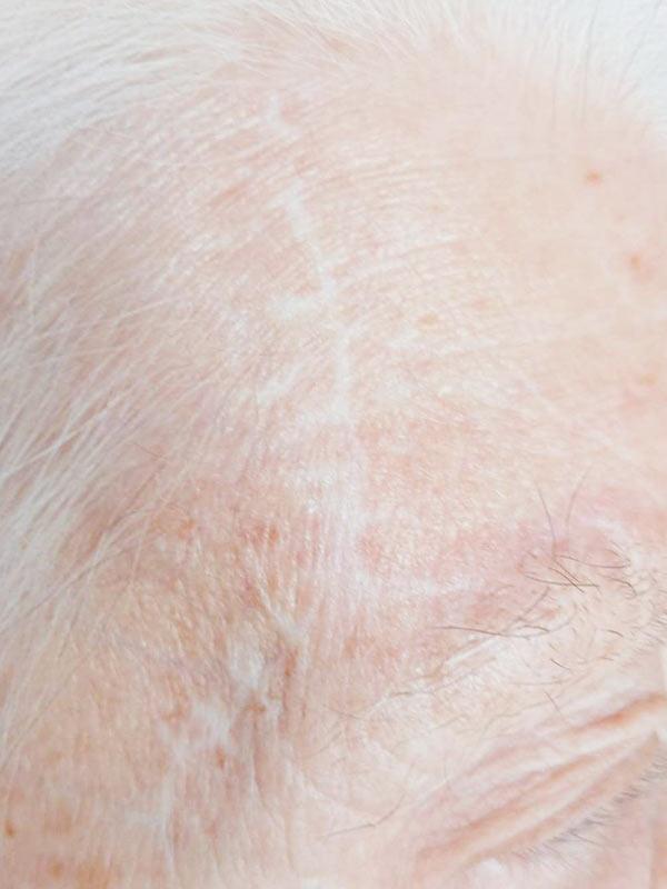 Удаление базалиомы методом Mohs Киев Удаление базалиомы методом Mohs Киев