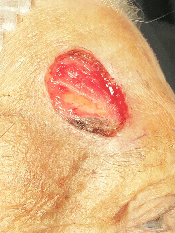 Удаление базальноклеточного рака кожи Киев Удаление базальноклеточного рака кожи Киев