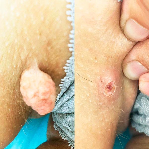 Удаление папиллом в интимной зоне Киев