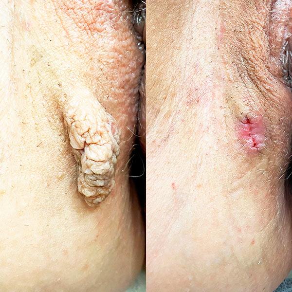 Комбинированное удаление папилломы в интимной зоне Киев