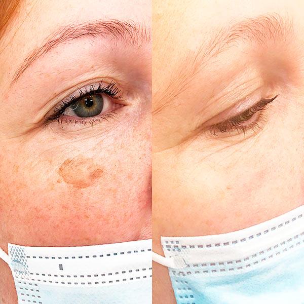 Лазерное удаление пигментации Киев