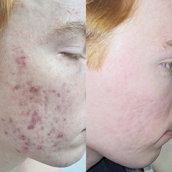 Лікування акне на обличчі Київ