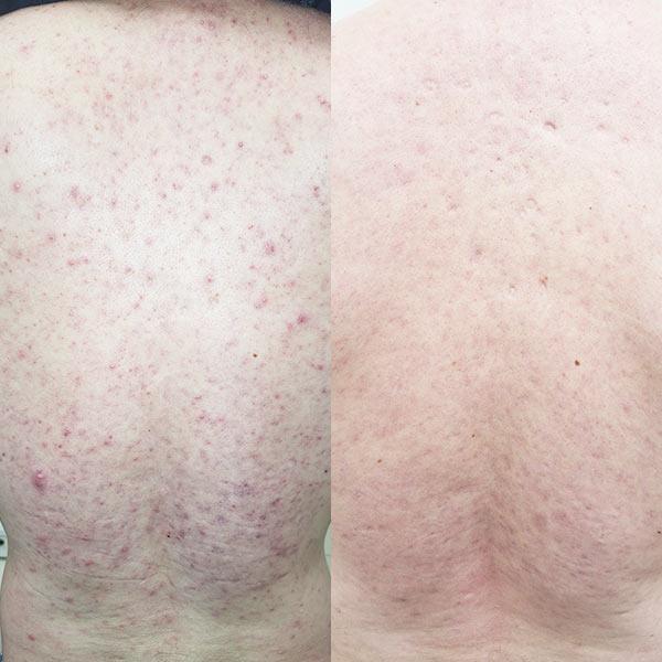 Лікування акне на спині Київ