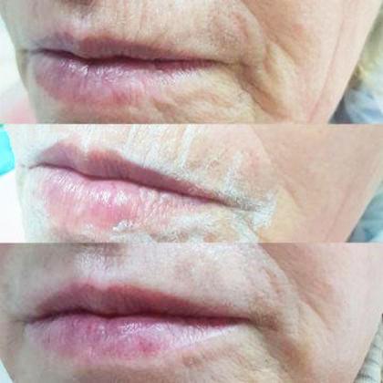 Контурная пластика носогубных складок