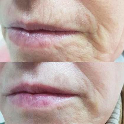 Контурная пластика носогубных складок