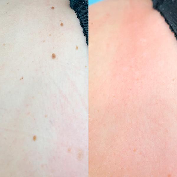 Удаление папиллом на теле лазером Киев