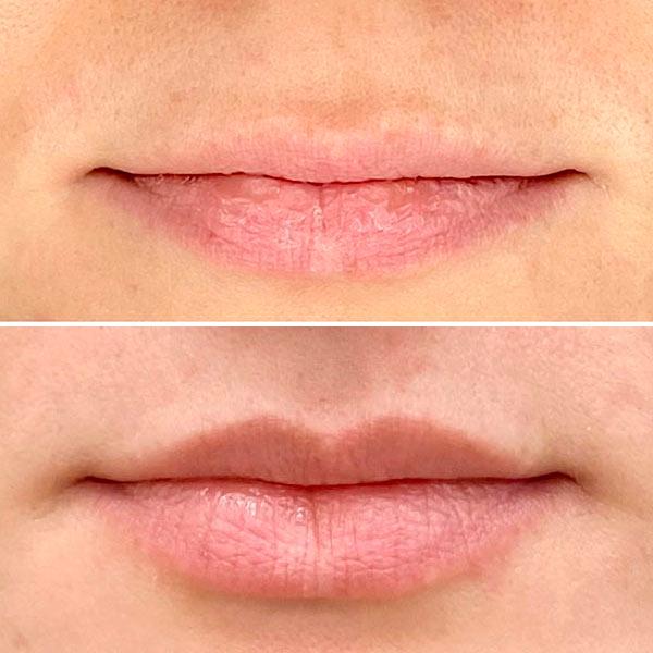 Хейлопластика Булхорн Київ