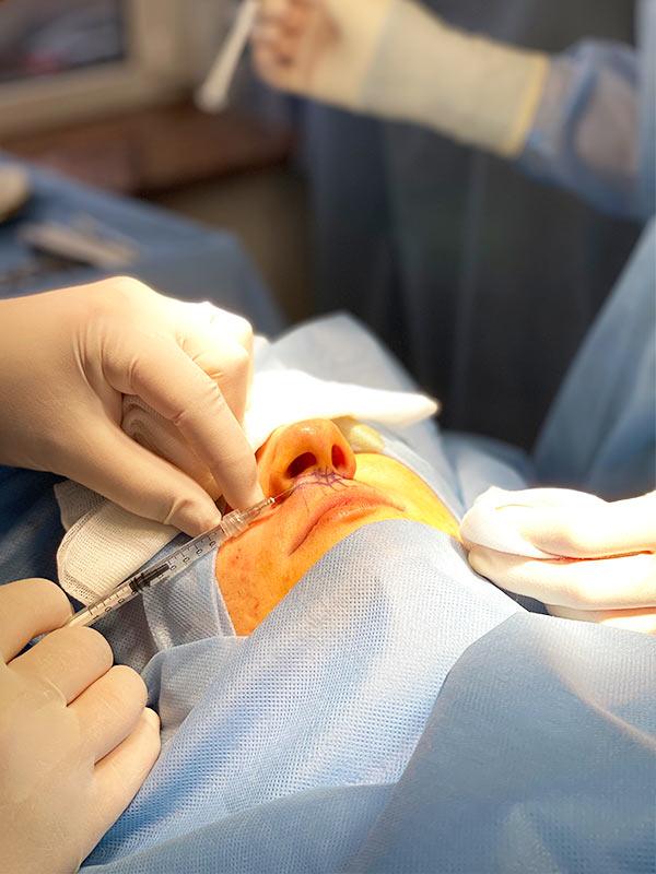 Хейлопластика Булхорн Киев Хейлопластика Булхорн Киев