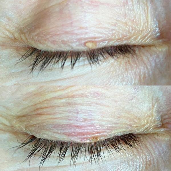 Удаление папилломы на веке лазером Киев