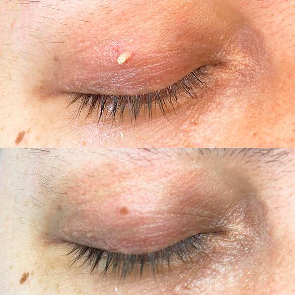 Лазерное удаление папиломы на веке Киев