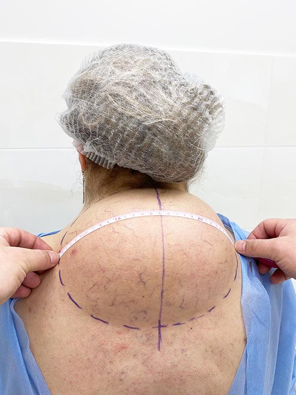 Розмітка перед видаленням вдовиного горба Київ