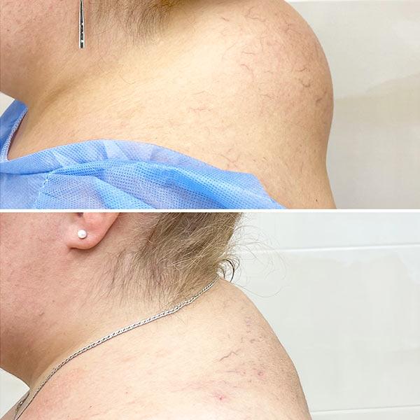 Липосакция - удаление климактерического горба Киев