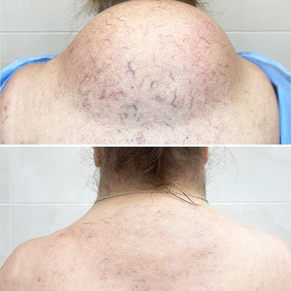 Ліпоаспірація вдовиного горба Київ