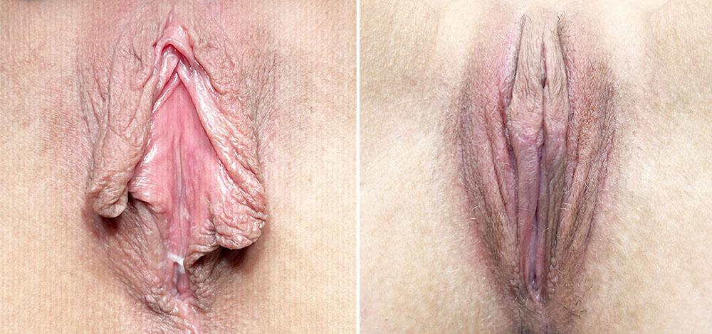 Лабіопластика Київ