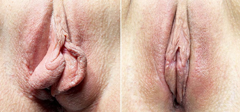 Лабиопластика + удаление кисты бартолиновой железы