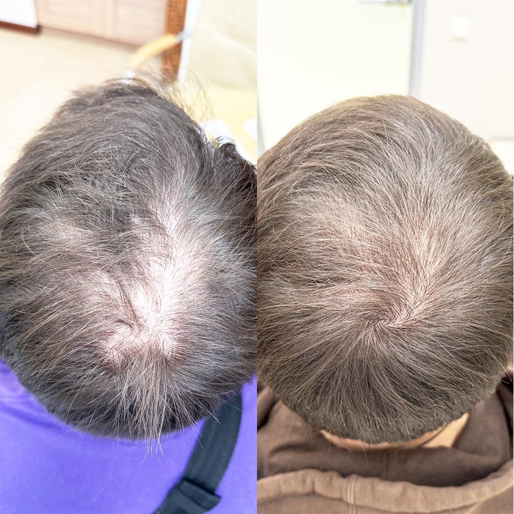 Лікування АГА - результат через 3,5 місяці Лікування АГА - результат через 3,5 місяці