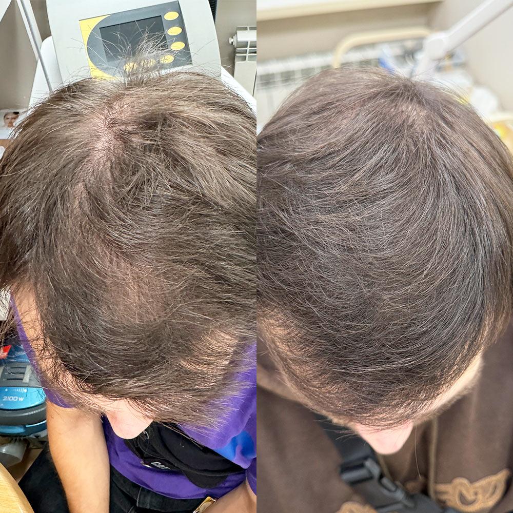 Мезотерапія Київ