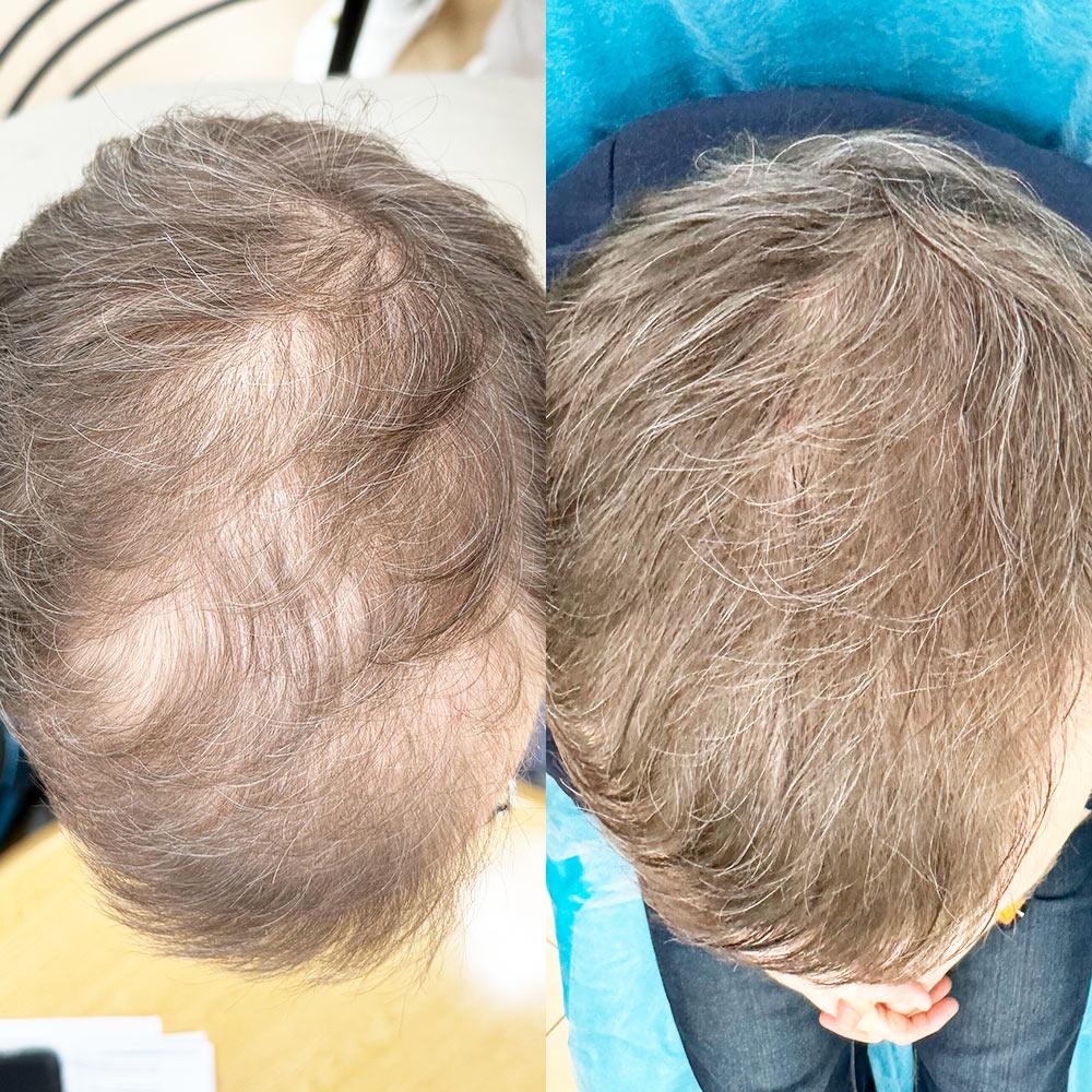 Лечение андрогенетической алопеции Киев