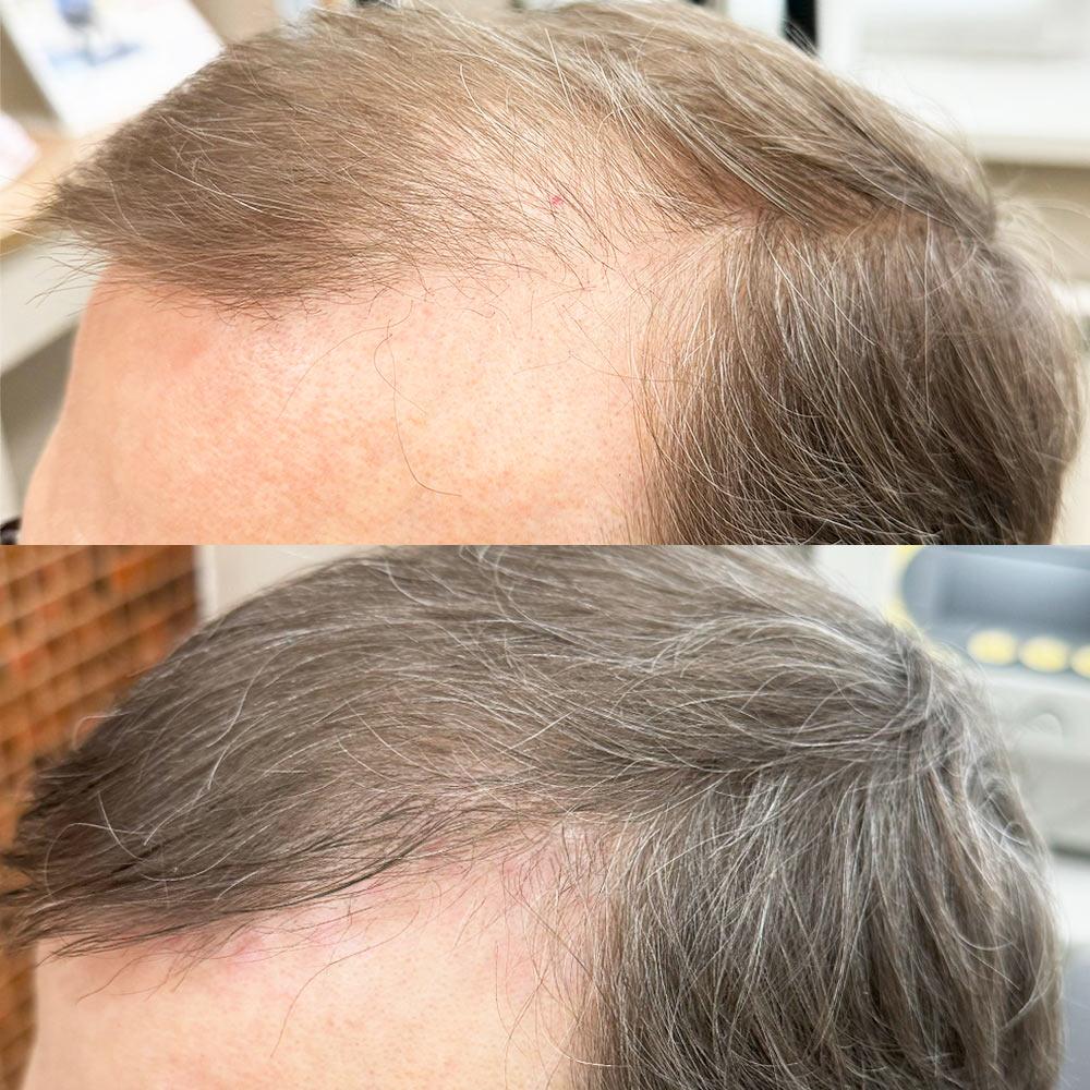 Лечение АГА Киев