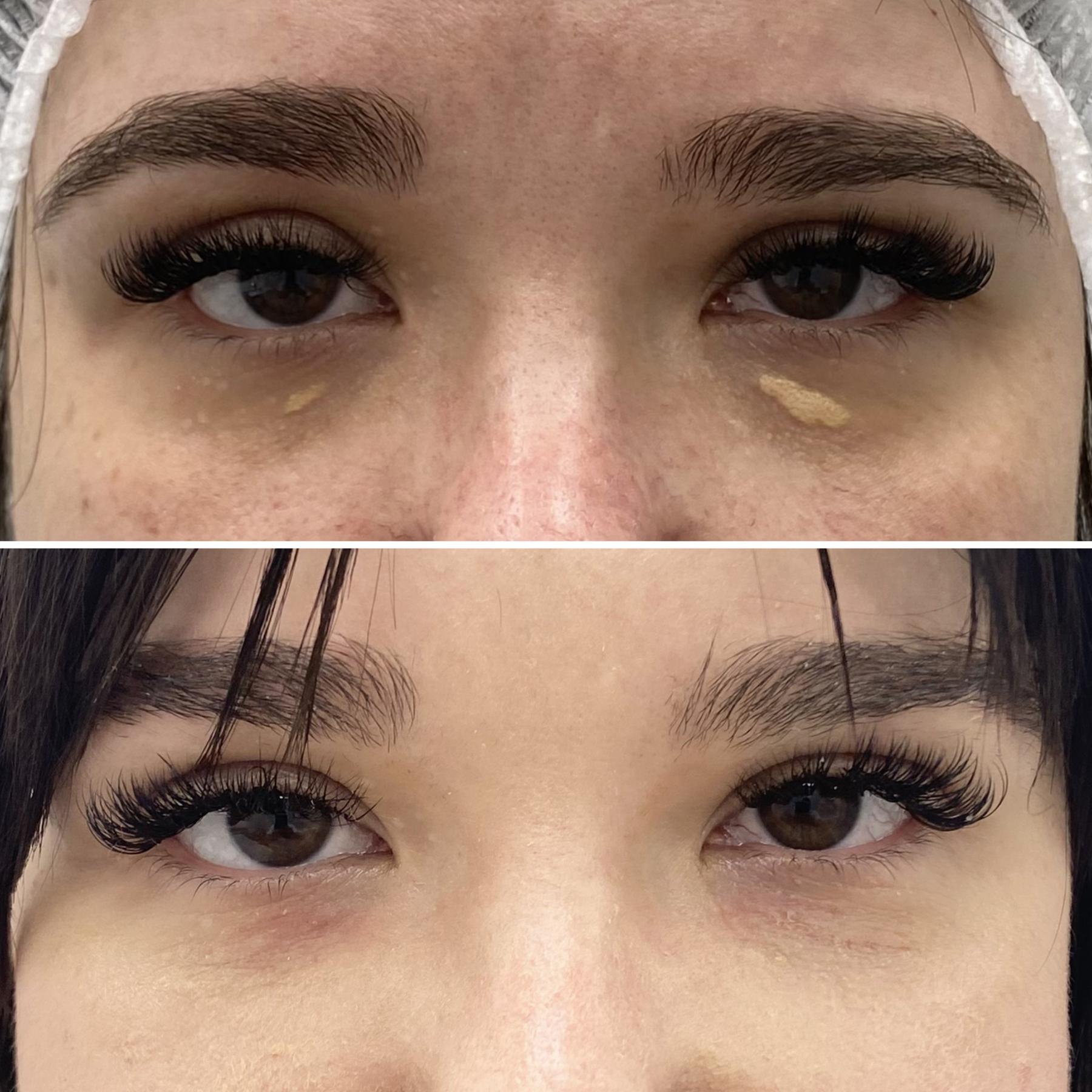 Удаление ксантелазмы Киев