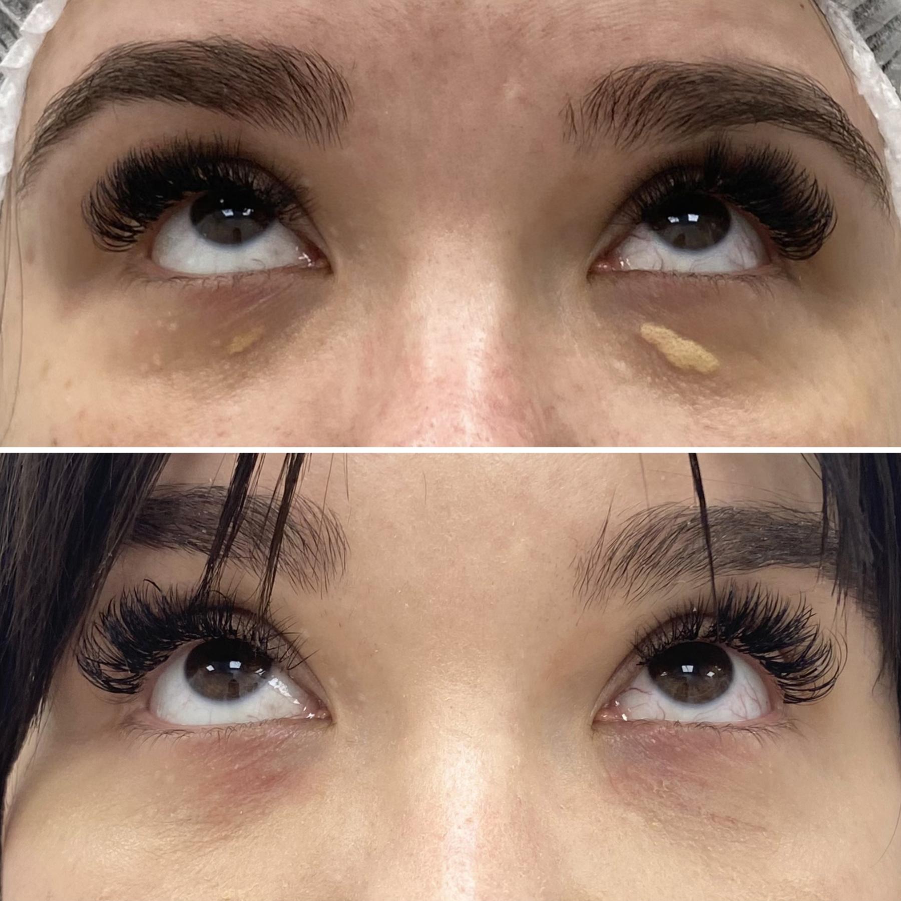 Удаление ксантелазмы Киев