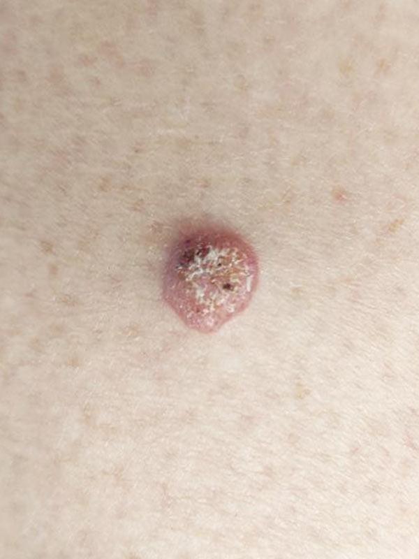 Хірургічне видалення невуса Київ