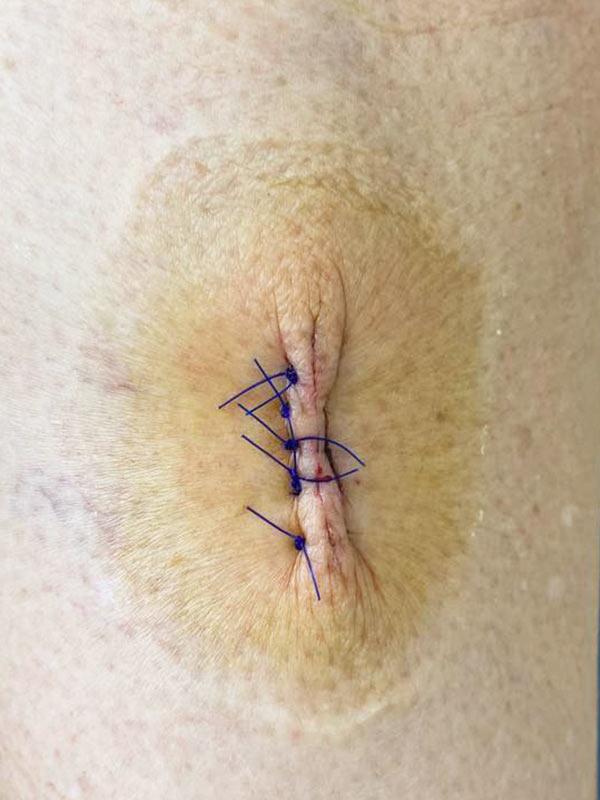 Хірургічне видалення невуса Київ