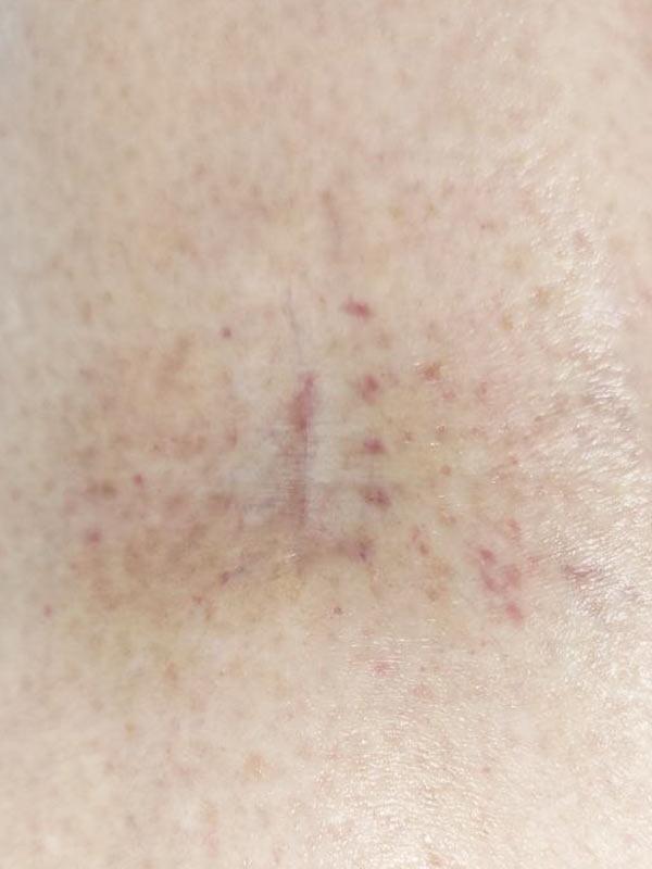 Хірургічне видалення невуса Київ