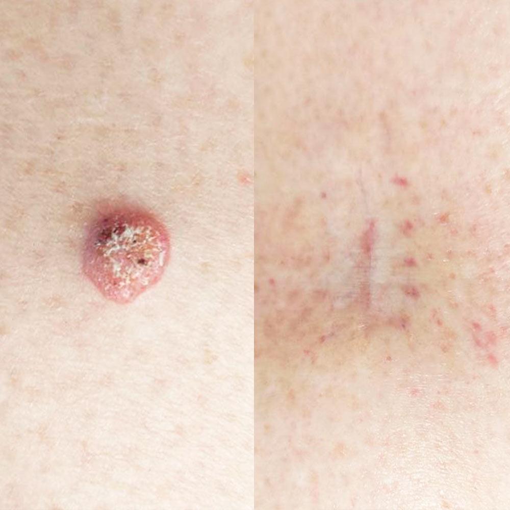 Хирургическое удаление невуса родинки Киев