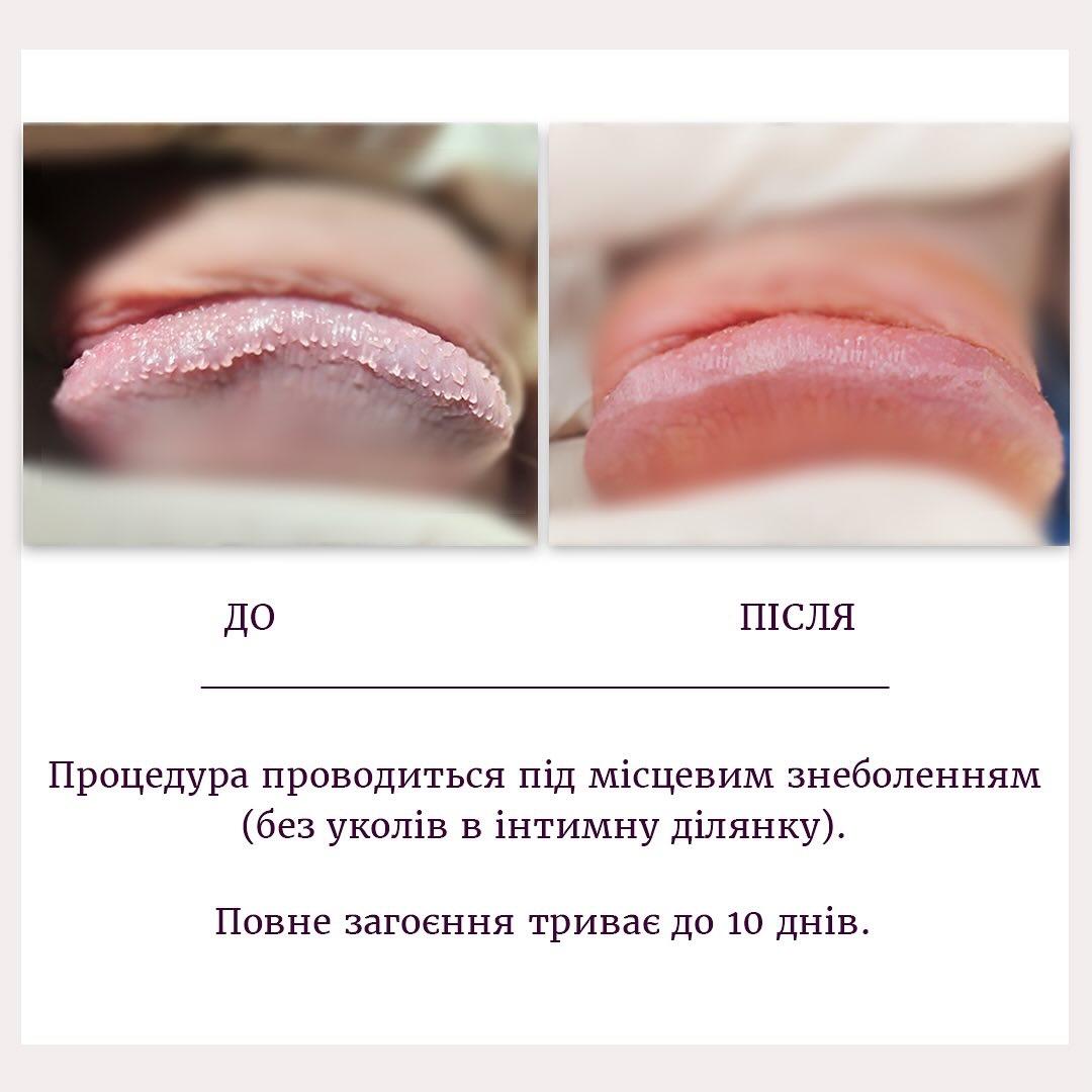 Результат до після видалення перламутрових папул Київ Результат до після видалення перламутрових папул Київ