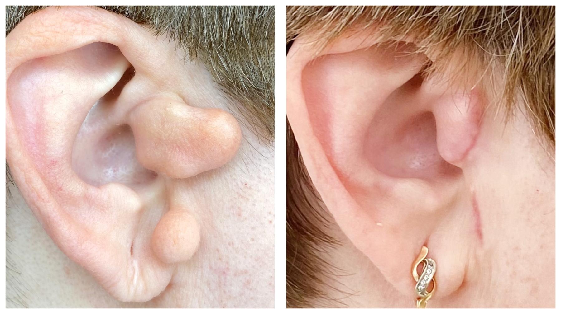 Реконстурктивна отопластика при аномалії розвитку зовнішнього вуха Київ